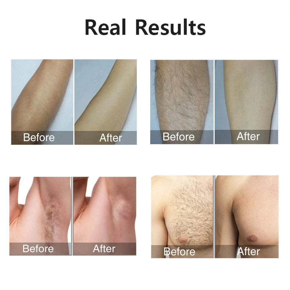 Portabler IPL Laser Epilator 999999 Blitzen - schmerzlos, Permanent Haarentferner - HIMMLICH.DE