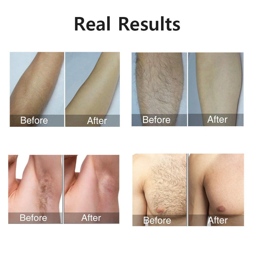 Portabler IPL Laser Epilator 999999 Blitzen - schmerzlos, Permanent Haarentferner - HIMMLICH.DE